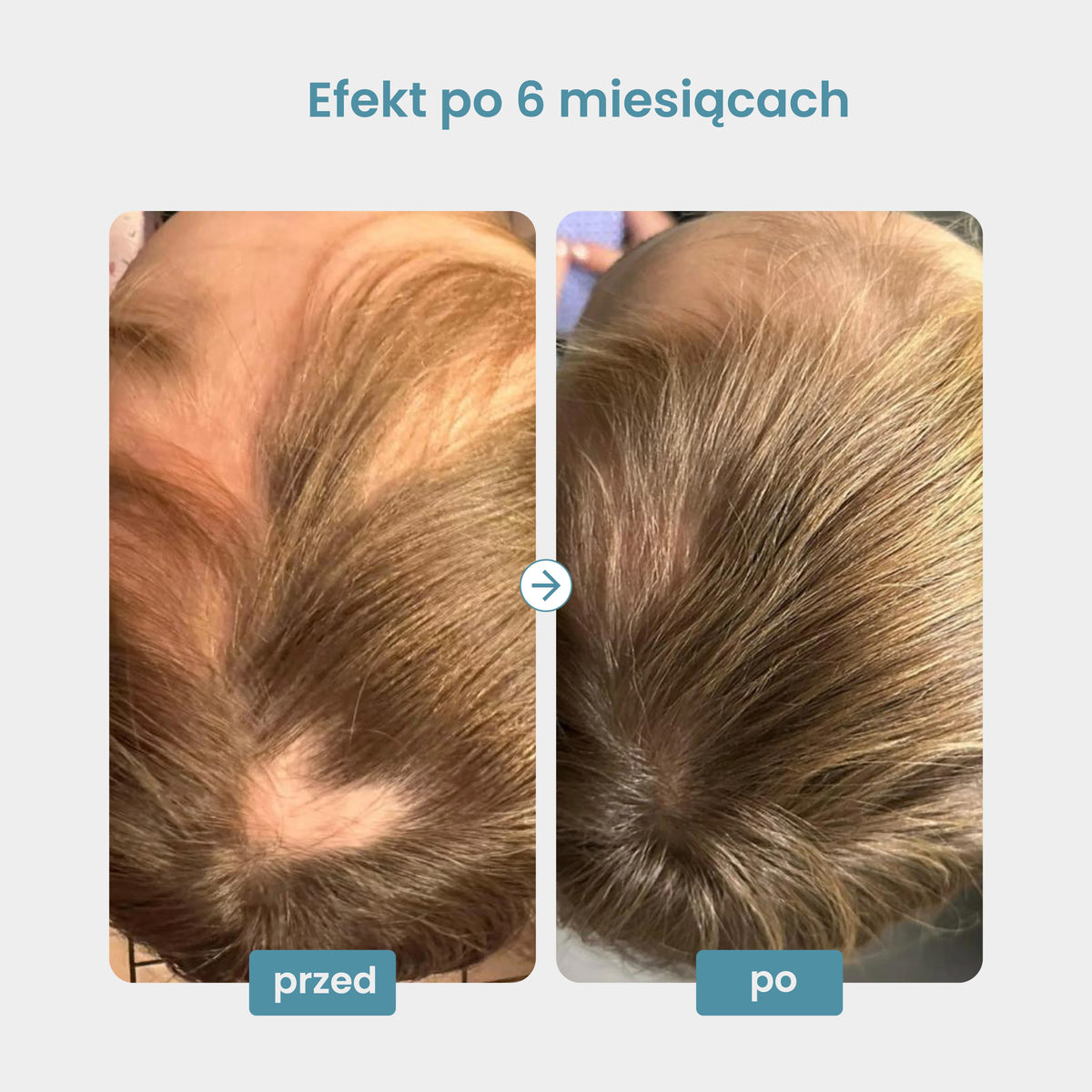 Kuracja 80 dni dla kobiet 18-45 lat, wzmacnia włosy, zapobiega wypadaniu i poprawia ich kondycję.